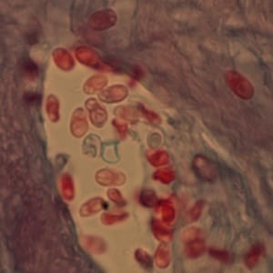 Figure C: Microsporidia spores from a corneal section, stained with trichrome.