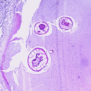 Figure A: Cross-section of an adult of <em>Oesophagostomum</em> sp. in a colon biopsy specimen from a patient from Africa, stained with H&E. Image taken at 40x magnification.