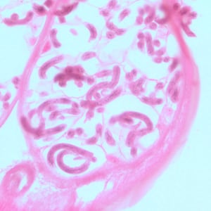Figure B: Microfilariae of <em>O. volvulus</em> within the uterus of an adult female. The specimen was taken from the same patient as in Figure A. Image taken at 500x magnification, oil.