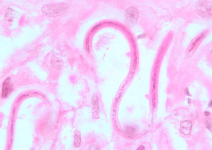 Figure C: Microfilariae of <em>O. volvulus</em> from a skin nodule of a patient from Zambia, stained with H&E. Image taken at 1000x oil magnification.