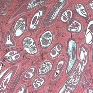 Figure D: Adult of <em>O. volvulus</em> in a subcutaneous nodule, stained with H&E.