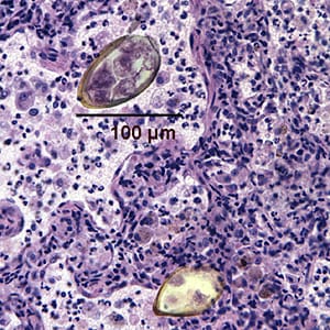 Figure A: Eggs of <em>Paragonimus</em> sp. taken from a lung biopsy stained with hematoxylin and eosin (H&E). These eggs measured 80-90 µm by 40-45 µm. The species was not identified in this case.