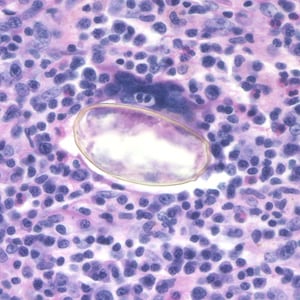 Figure B: Egg of <em>Paragonimus</em> sp. taken from a lung biopsy stained with hematoxylin and eosin (H&E). This egg measured 80-90 µm by 40-45 µm. The species was not identified in this case.