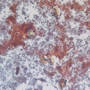 Figure C: Egg of <em>P. kellicotti</em> in a Pap-stained bronchial alveolar lavage (BAL) specimen at 100x magnification. Image courtesy of Dr. Gary Procop.