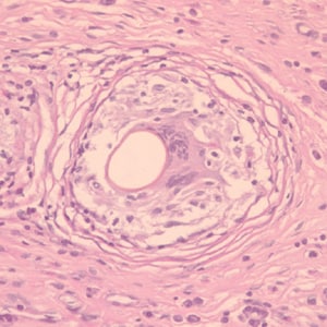 Figure A: Cross-section of an egg of <em>P. kellicotti</em> in a lung biopsy specimen, stained with periodic acid-Schiff (PAS) stain. Image courtesy of Dr. Gary Procop.