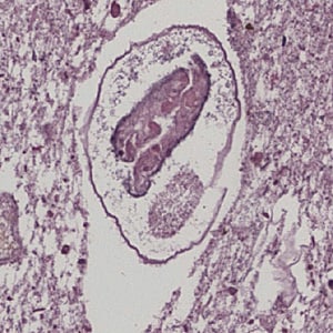 Figure E: Adult of <em>P. kellicotti</em> taken from a lung biopsy specimen stained with H&E. This worm is in poor condition, indicating it was probably an old infection. Image courtesy of Dr. Miguel Madariaga, University of Nebraska Medical Center.