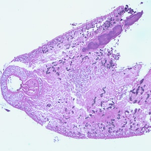 Figure C: Adult of <em>Paragonimus</em> sp., taken from a lung biopsy specimen stained with hematoxylin and eosin (H&E). Note the presence of the oral sucker. The species was not identified in this case.