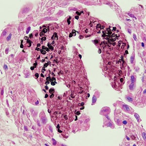 Figure A: Cysts of <em>P. jirovecii</em> in lung tissue, stained with methenamine silver and hematoxylin and eosin (H&E). The walls of the cysts are stained black; the intracystic bodies are not visible with this stain.