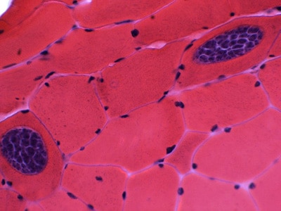 Figure A: Sarcocysts of <em>Sarcocystis</em> sp. in muscle tissue, stained with hematoxylin and eosin (H&E). Notice the bradyzoites within each sarcocyst. Images courtesy of the William Beaumont Hospital, Royal Oak, MI.