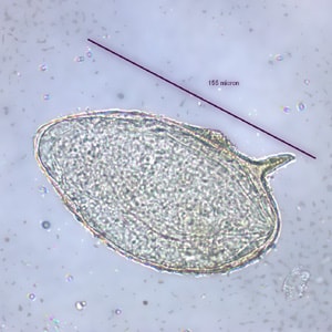 Figure B: Egg of <em>S. mansoni</em> in an unstained wet mount. Images courtesy of the Wisconsin State Laboratory of Hygiene.