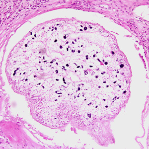 CDC DPDx Sparganosis