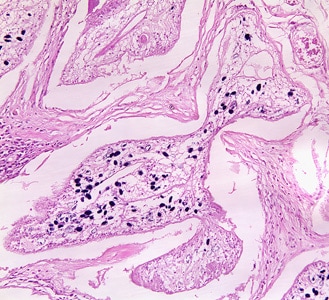 Figure C: Proliferating sparganum in groin tissue of a patient from Paraguay, stained with hematoxylin and eosin (H&E). 