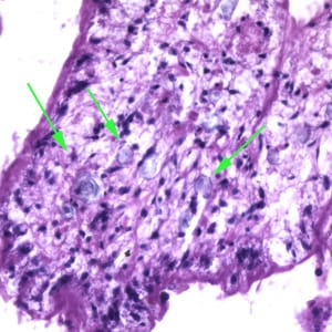 Figure B: Higher magnification of the sparganum in Figure A. In this image, calcareous corpuscles (green arrows) can be seen. 