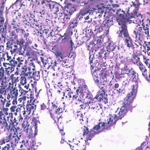 Figure C: Proliferating sparganum in lung tissue in a patient from Taiwan, stained with H&E. 