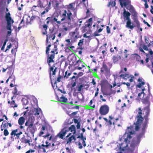 Figure D: Higher magnification of the sparganum in Figure C. In this image, calcareous corpuscles (green arrows) can be seen.