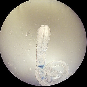 Figure B: Sparganum removed from the chest wall of a patient. The worm measured about 70 mm long. Images from a specimen courtesy of the Oklahoma State Department of Health. 
