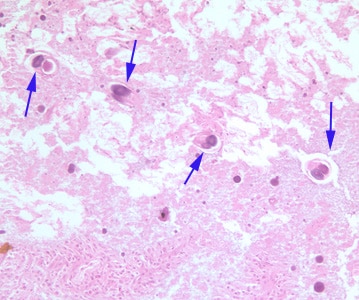 Figure A: Cross-sections of adult parasitic female <em>S. stercoralis</em> (blue arrows) in small intestine tissue, stained with H&E. Image taken at 200x magnification.