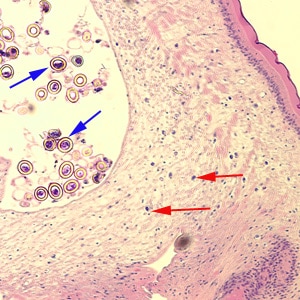 Figure B: Cross-section of a proglottid of <em>Taenia</em> sp., stained with H&E. Note the thick outer tegument and the loose parenchyma filling the body. Calcareous corpuscles (red arrows), characteristic of the cestodes, can be seen in the parenchyma. Eggs (blue arrows) can also be seen. Image courtesy of the Washington State Public Health Laboratories.