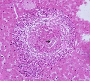Figure D. <em>Toxocara canis</em> longitudinal section (arrow) in the liver of an infected monkey. Note the prominent granulomatous reaction and host infiltrate around the larva (20x magnification).