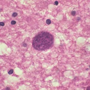 Figure A: <em>Toxoplasma gondii</em> cyst in brain tissue stained with hematoxylin and eosin.