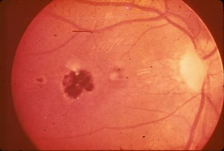 Figure C: Central, healed retinochoroiditis.