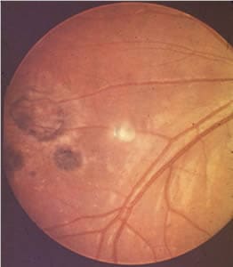 Figure B: Peripheral retinochoroiditis. 