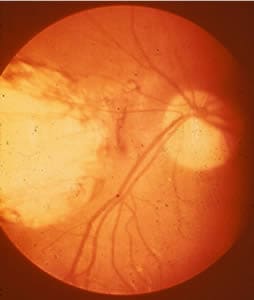 Figure A: Severe, active retinochoroiditis. 