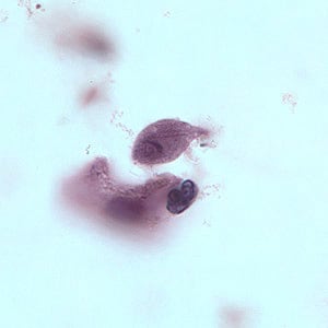 Figure B: Trophozoite of <em>T. vaginalis</em> in a vaginal smear, stained with Giemsa. 