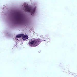 Figure C: Trophozoite of <em>T. vaginalis</em> in a vaginal smear, stained with Giemsa.