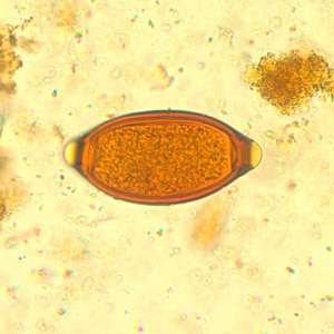 Figure A: Egg of <em>T. trichiura</em> in an iodine-stained wet mount.