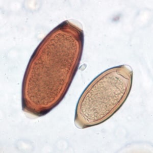 Figure D: Eggs of <em>T. trichiura</em> in a wet mount, showing variability in size in the species.