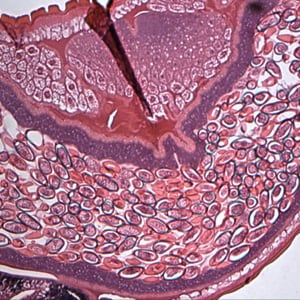 Figure A: Cross-section of a gravid female <em>T. trichiura</em> stained with Hamp;E, showing numerous eggs. Magnification at 100x. Image courtesy of the Oregon State Public Heath Laboratory.