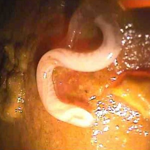 Figure A: Posterior end of an adult <em>T. trichiura</em>, taken during a colonoscopy. Image courtesy of Duke University Medical Center. 