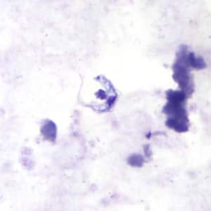 Figure B: <em>Trypansoma brucei</em> ssp. in a thick blood smear stained with Giemsa.