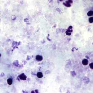 Figure A: <em>T. cruzi</em> trypomastigotes in a thick blood smear stained with Giemsa.
