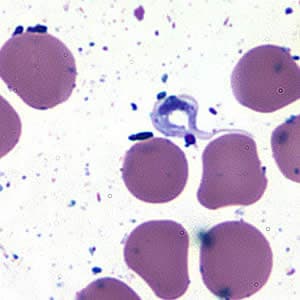 Figure B: <em>Trypanosoma cruzi</em> trypomastigote in cerebrospinal fluid (CSF) stained with Giemsa.