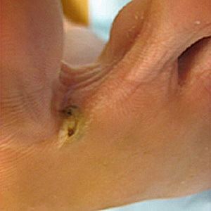 Figure B: Gross lesion on a patient's foot caused by <em>T. penetrans</em>. Image courtesy of Drs. Mohammed Asmal and Rocio M. Hurtado. Image first appeared at Partners' Infectious Disease Images (http://www.idimages.orgExternal Web Site Icon), whose content is copyrighted by Partners Healthcare System, Inc., and is used with permission.
