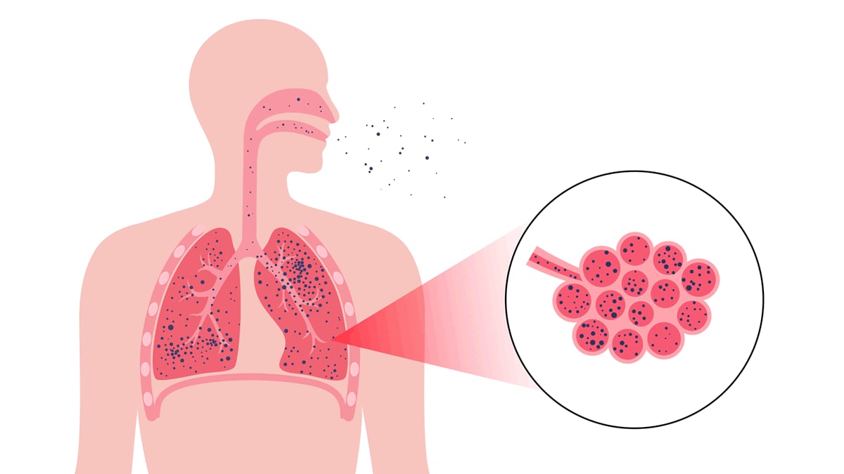 Illustration showing dust in alveoli
