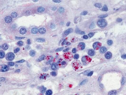 Immunohistochemical stain demonstrating Ehrlichia chaffeensis morulae (red) within monocytes in the kidney of a patient with ehrlichiosis