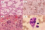 Thumbnail of Histopathologic findings of lung biopsy (patient 1) and bone marrow biopsy (patient 2) in two patients with severe acute respiratory syndrome. A: diffuse interstitial pneumonitis with mononuclear cell infiltrating in the mildly thickened alveolar septum (hematoxylin and eosin stain, X100). B: desquamated, multinucleated syncytial giant cell without cytoplasmic inclusion (hematoxylin and eosin stain, X400). C: abundant CD68-positive histiocytes (X100). D: a macrophage ingested with e
