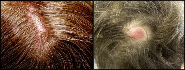 Patients with Rickettsia slovaca infection. On the left, inoculation lesion on the scalp; on the right, residual alpecia.