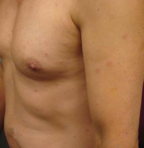 Multiple papules on torso, upper arms, and legs.