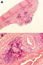 Thumbnail of Histopathologic appearance of abdominal aortic biopsy sample from 35-year-old mink farmer in Denmark who had been exposed to Aleutian mink disease parvovirus−infected mink for 10 years (patient 1). A) Perivascular, adventitial lymphoplasmacytoid infiltration. Original magnification ×4. B) Minimal atherosclerotic changes. Original magnification ×20.