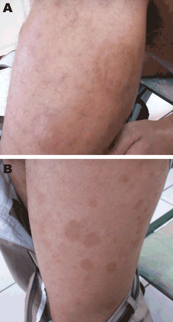 Erythema migrans–like rash on the left leg of a 28-year-old patient. A) Characteristic rash of erythema migrans (annular macular lesion that is erythematous with central clearing). B) Spread of the lesions to the rest of the leg.