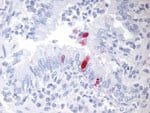 Thumbnail of Lung section from an American badger showing immunohistochemical staining (red chromogen) specific for the pandemic (H1N1) 2009 virus within the nucleus and cytoplasm of bronchiolar epithelial cells and concurrent inflammatory cell infiltrates; hematoxylin counterstain. Original magnification ×158.