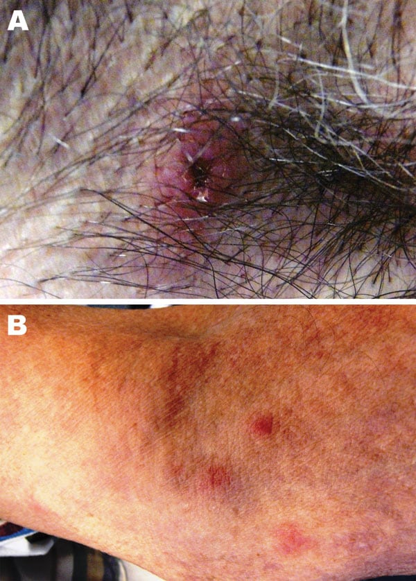 Images of lesion in the patient caused by bite from lone star tick. A) Erythematous circular lesion in right armpit at site of tick bite with induration and a necrotic center. B) Maculopapular rash involving the inferior portion of the arm. Source: Julie M. Bradley.