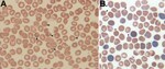 Thumbnail of A) Giemsa-stained thin blood smear for an 8-year-old boy from China showing erythrocytes with typical ring forms, paired pyriforms, and tetrads of a Babesia sp. (arrows). B) Giemsa-stained thin blood smear for a mouse with severely combined immunodeficiency, which had been injected with blood from the patient, showing Babesia sp.–infected erythrocytes (arrows). Original magnifications ×1,000.