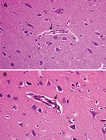 Thumbnail of Brain tissue of an unvaccinated control pig (A) and pig inoculated with pseudorabies virus strain HeN1 (B). Arrows indicate lymphocyte infiltration around the small blood vessels in the brain cortex. Original magnification ×100.