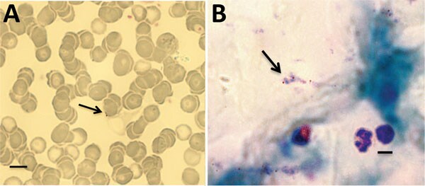 Babesia microti parasites (arrows) detected in Giemsa-stained thin (A) and thick (B) blood smears from persons living in 2 rural communities, southeastern Bolivia, 2013.