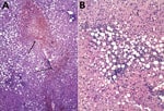Thumbnail of Histopathologic appearance of liver biopsy sample from woman with fatal human monocytic ehrlichiosis, Mexico, 2013. A) Necrotic hepatic lesions in a patchy distribution (arrows). Hematoxylin and eosin (H&amp;E) stain; original magnification ×100. B) Macrovesicular steatosis and inflammatory lymphocytic infiltrate. H&amp;E stain; original magnification ×200. 